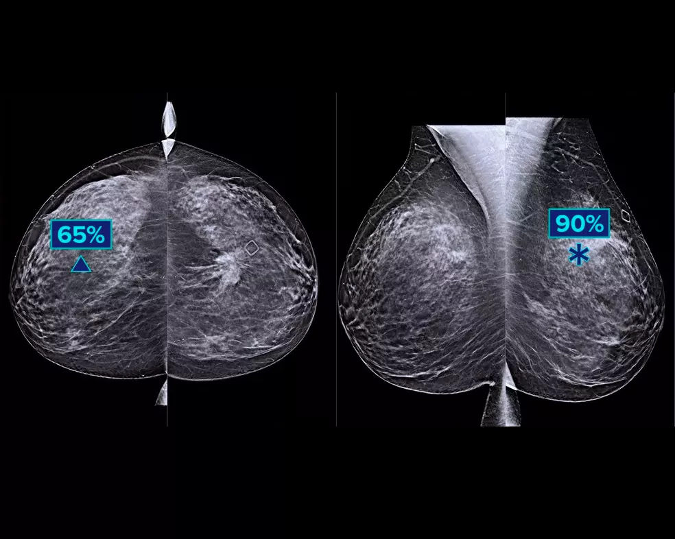 Breast screening image two screens